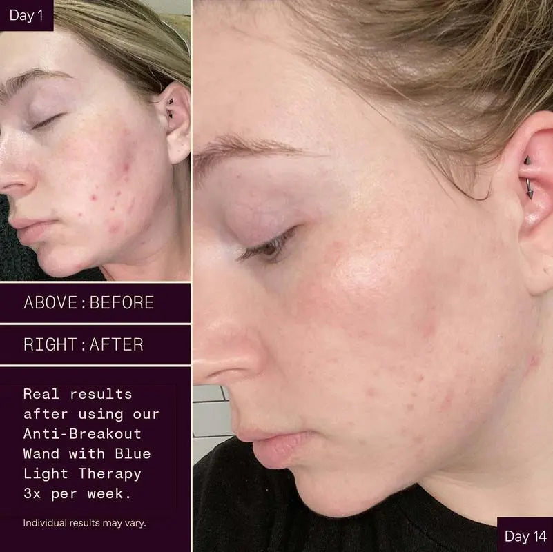 Bye Acne: 3 Minute Light Therapy Spot Treatment