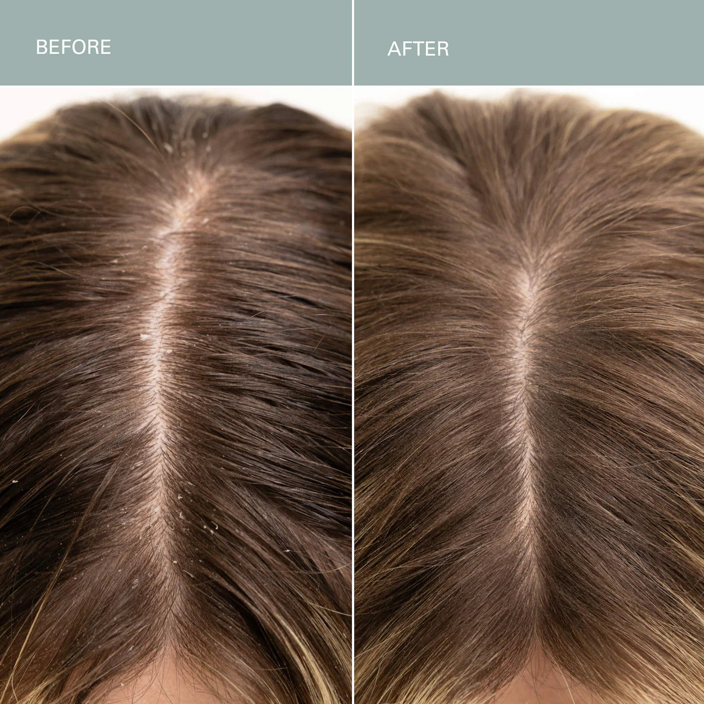 Split image showing a scalp before and after using Salt Scalp Scrub Exfoliating Shampoo, revealing dandruff-free, smoother hair post-treatment.